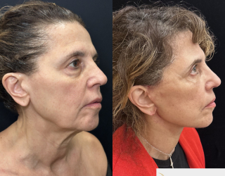 CC-71-y.o-female-who-is-3-months-out-from-Deep-Plane-Facelit-Necklift-Upper-and-lower-blepharoplasty-and-facial-fat-transfer-1-2