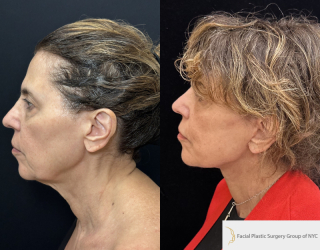 CC-71-y.o-female-who-is-3-months-out-from-Deep-Plane-Facelit-Necklift-Upper-and-lower-blepharoplasty-and-facial-fat-transfer-1-3