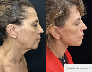 CC-71-y.o-female-who-is-3-months-out-from-Deep-Plane-Facelit-Necklift-Upper-and-lower-blepharoplasty-and-facial-fat-transfer-1-4