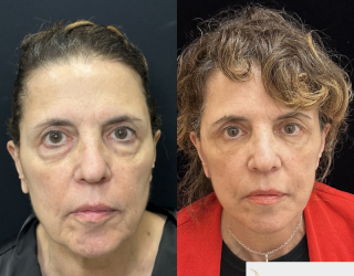 CC-71-y.o-female-who-is-3-months-out-from-Deep-Plane-Facelit-Necklift-Upper-and-lower-blepharoplasty-and-facial-fat-transfer-1-5