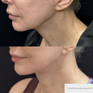 CM-61-year-old-female-who-is-3-months-out-from-Deep-Plane-Facelift-and-Necklift-1-2