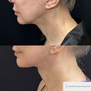 CM-61-year-old-female-who-is-3-months-out-from-Deep-Plane-Facelift-and-Necklift-1-3
