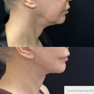 CM-61-year-old-female-who-is-3-months-out-from-Deep-Plane-Facelift-and-Necklift-1-4