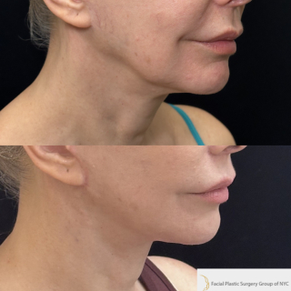 CM-61-year-old-female-who-is-3-months-out-from-Deep-Plane-Facelift-and-Necklift-1-5