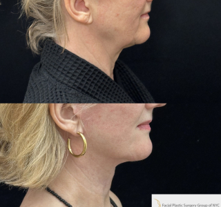 DB-68-y.o-female-who-is-6-months-post-op-from-Deep-Plane-Facelift-and-Necklift-1-3
