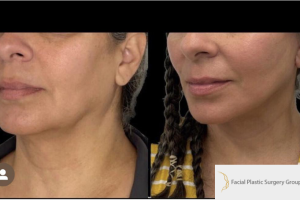 47-y.o-female-who-underwent-Deep-Plane-Facelift-Extended-Deep-plane-Neck-Lift-1