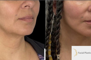 47-y.o-female-who-underwent-Deep-Plane-Facelift-Extended-Deep-plane-Neck-Lift-2