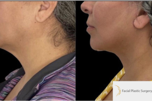 47-y.o-female-who-underwent-Deep-Plane-Facelift-Extended-Deep-plane-Neck-Lift-3
