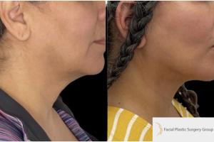 47-y.o-female-who-underwent-Deep-Plane-Facelift-Extended-Deep-plane-Neck-Lift-4