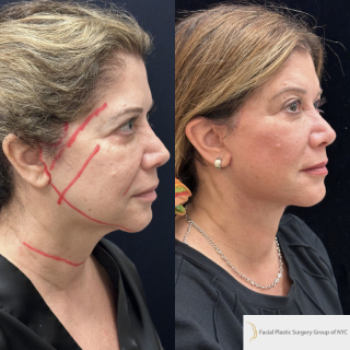 DR-59-y.o-female-who-is-3-months-out-from-Deep-Plane-Facelift-Necklift-and-Facial-Fat-Transfer-1-1
