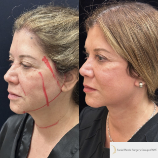 DR-59-y.o-female-who-is-3-months-out-from-Deep-Plane-Facelift-Necklift-and-Facial-Fat-Transfer-1-2