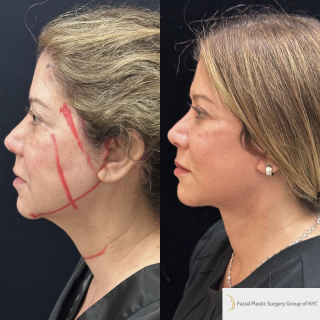 DR-59-y.o-female-who-is-3-months-out-from-Deep-Plane-Facelift-Necklift-and-Facial-Fat-Transfer-1-3