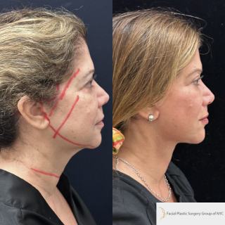 DR-59-y.o-female-who-is-3-months-out-from-Deep-Plane-Facelift-Necklift-and-Facial-Fat-Transfer-1-4
