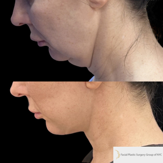 IE-53-y.o-female-who-is-3-months-out-from-Deep-Plane-Facelift-and-Necklift-1-1