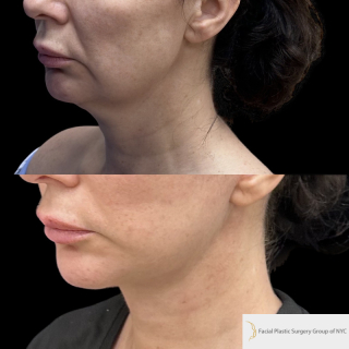 IE-53-y.o-female-who-is-3-months-out-from-Deep-Plane-Facelift-and-Necklift-1-2