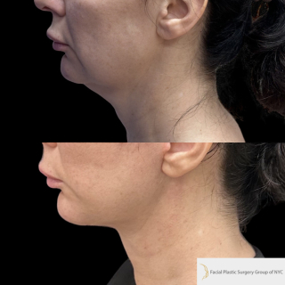 IE-53-y.o-female-who-is-3-months-out-from-Deep-Plane-Facelift-and-Necklift-1-3