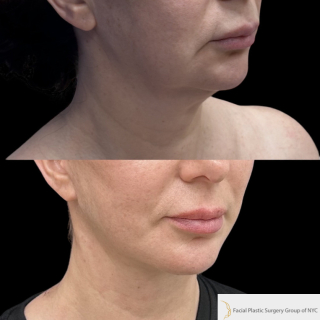 IE-53-y.o-female-who-is-3-months-out-from-Deep-Plane-Facelift-and-Necklift-1-4