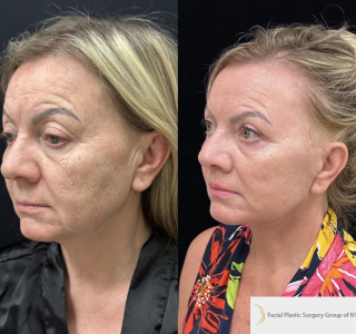 IM-58-y.o-female-who-is-3-months-out-from-Deep-Plane-Facelift-Necklift-Upper-Blepharoplasty-Lip-Lift-and-CO2-Laser-Resurfacing-1-1