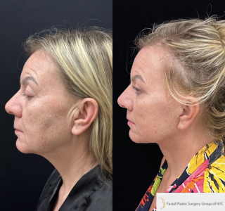 IM-58-y.o-female-who-is-3-months-out-from-Deep-Plane-Facelift-Necklift-Upper-Blepharoplasty-Lip-Lift-and-CO2-Laser-Resurfacing-1-2