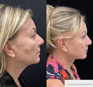 IM-58-y.o-female-who-is-3-months-out-from-Deep-Plane-Facelift-Necklift-Upper-Blepharoplasty-Lip-Lift-and-CO2-Laser-Resurfacing-1-3