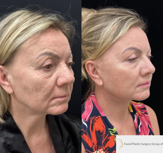 IM-58-y.o-female-who-is-3-months-out-from-Deep-Plane-Facelift-Necklift-Upper-Blepharoplasty-Lip-Lift-and-CO2-Laser-Resurfacing-1-4