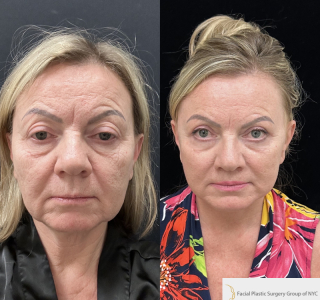 IM-58-y.o-female-who-is-3-months-out-from-Deep-Plane-Facelift-Necklift-Upper-Blepharoplasty-Lip-Lift-and-CO2-Laser-Resurfacing-1-5