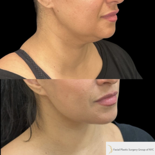 LG-51-y.o-female-who-is-3-months-out-from-Deep-Plane-Facelift-Necklift-1-1