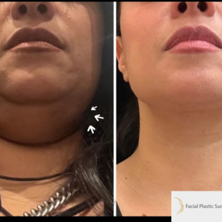 LG-51-y.o-female-who-is-3-months-out-from-Deep-Plane-Facelift-Necklift-1-2