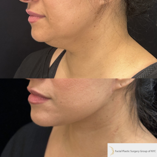 LG-51-y.o-female-who-is-3-months-out-from-Deep-Plane-Facelift-Necklift-1-3