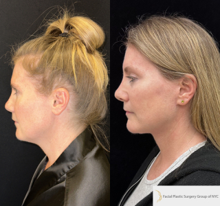 LH-54-y.o-female-6-months-after-Deep-Plane-Facelift-and-Necklift-1-1