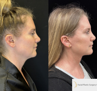 LH-54-y.o-female-6-months-after-Deep-Plane-Facelift-and-Necklift-1-2
