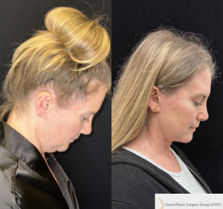 LH-54-y.o-female-6-months-after-Deep-Plane-Facelift-and-Necklift-1-3