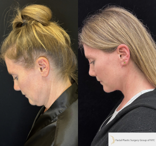 LH-54-y.o-female-6-months-after-Deep-Plane-Facelift-and-Necklift-1-4