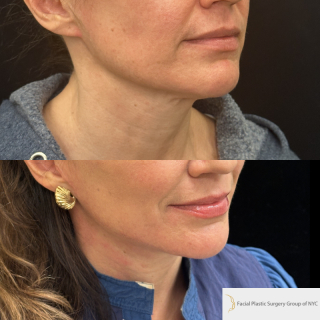 MN-47-y.o-female-who-is-now-6-months-out-from-Deep-Plane-Facelift-Necklift-1-1