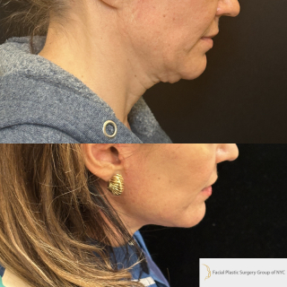 MN-47-y.o-female-who-is-now-6-months-out-from-Deep-Plane-Facelift-Necklift-1-3