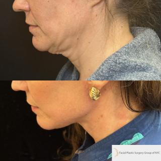 MN-47-y.o-female-who-is-now-6-months-out-from-Deep-Plane-Facelift-Necklift-1-4