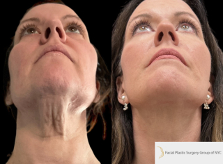 NM-44-y.o-female.-She-underwent-Deep-Plane-Facelift-Necklift-and-Facial-Fat-Transfer-1-1