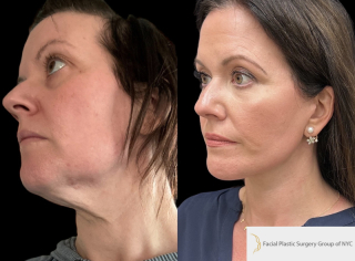 NM-44-y.o-female.-She-underwent-Deep-Plane-Facelift-Necklift-and-Facial-Fat-Transfer-1-2