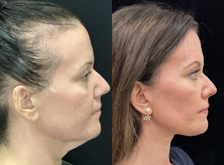 NM-44-y.o-female.-She-underwent-Deep-Plane-Facelift-Necklift-and-Facial-Fat-Transfer-1-3