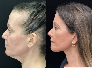 NM-44-y.o-female.-She-underwent-Deep-Plane-Facelift-Necklift-and-Facial-Fat-Transfer-1-4