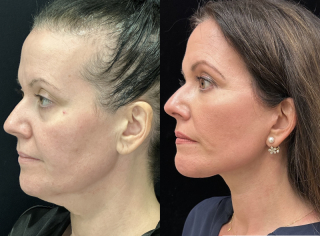 NM-44-y.o-female.-She-underwent-Deep-Plane-Facelift-Necklift-and-Facial-Fat-Transfer-1-5