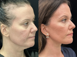 NM-44-y.o-female.-She-underwent-Deep-Plane-Facelift-Necklift-and-Facial-Fat-Transfer-1-6