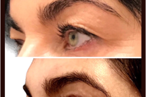 47-y.o-female-who-underwent-upper-eyelid-blepharoplasty-1