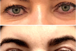 47-y.o-female-who-underwent-upper-eyelid-blepharoplasty-2