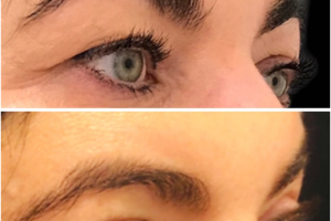 47-y.o-female-who-underwent-upper-eyelid-blepharoplasty-3