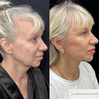 OC-63-y.o-female-who-is-now-3-months-out-from-Deep-Plane-Facelift-Necklift-and-CO2-laser-resurfacing-1-1