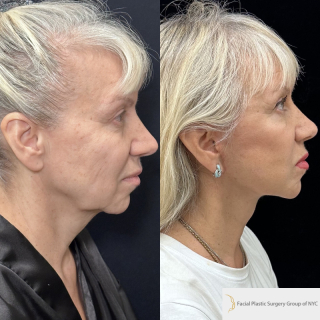 OC-63-y.o-female-who-is-now-3-months-out-from-Deep-Plane-Facelift-Necklift-and-CO2-laser-resurfacing-1-2