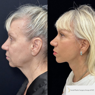 OC-63-y.o-female-who-is-now-3-months-out-from-Deep-Plane-Facelift-Necklift-and-CO2-laser-resurfacing-1-3