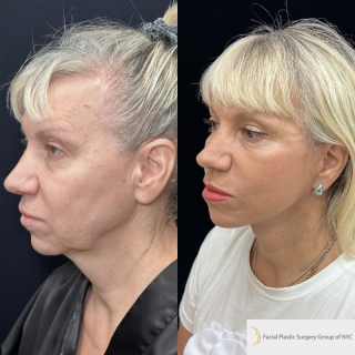 OC-63-y.o-female-who-is-now-3-months-out-from-Deep-Plane-Facelift-Necklift-and-CO2-laser-resurfacing-1-4