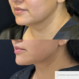 SG-49-y.o-female-who-is-6-months-out-from-Deep-Plane-Facelift-and-Necklift-1-1